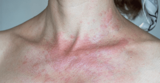 prirodni lek za alergiju