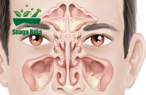 prirodno lecenje upale sinusa