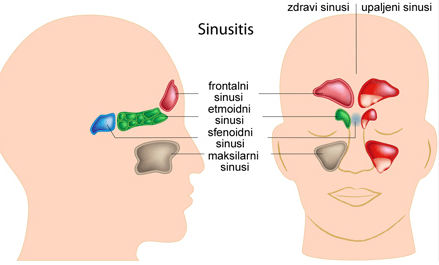 prirodno lecenje upale sinusa