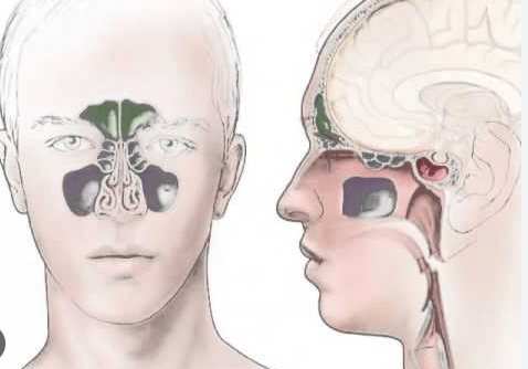 prirodno lecenje upale sinusa