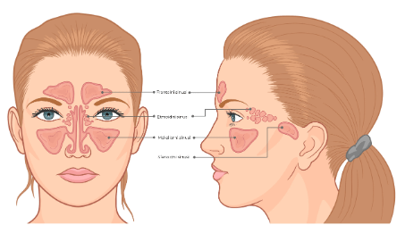 prirodno lecenje upale sinusa